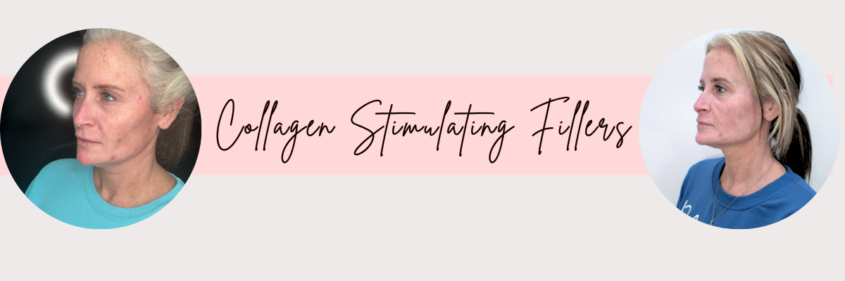 Collagen Stimulating Fillers at Taft Aesthetics LLC in Wilson NC