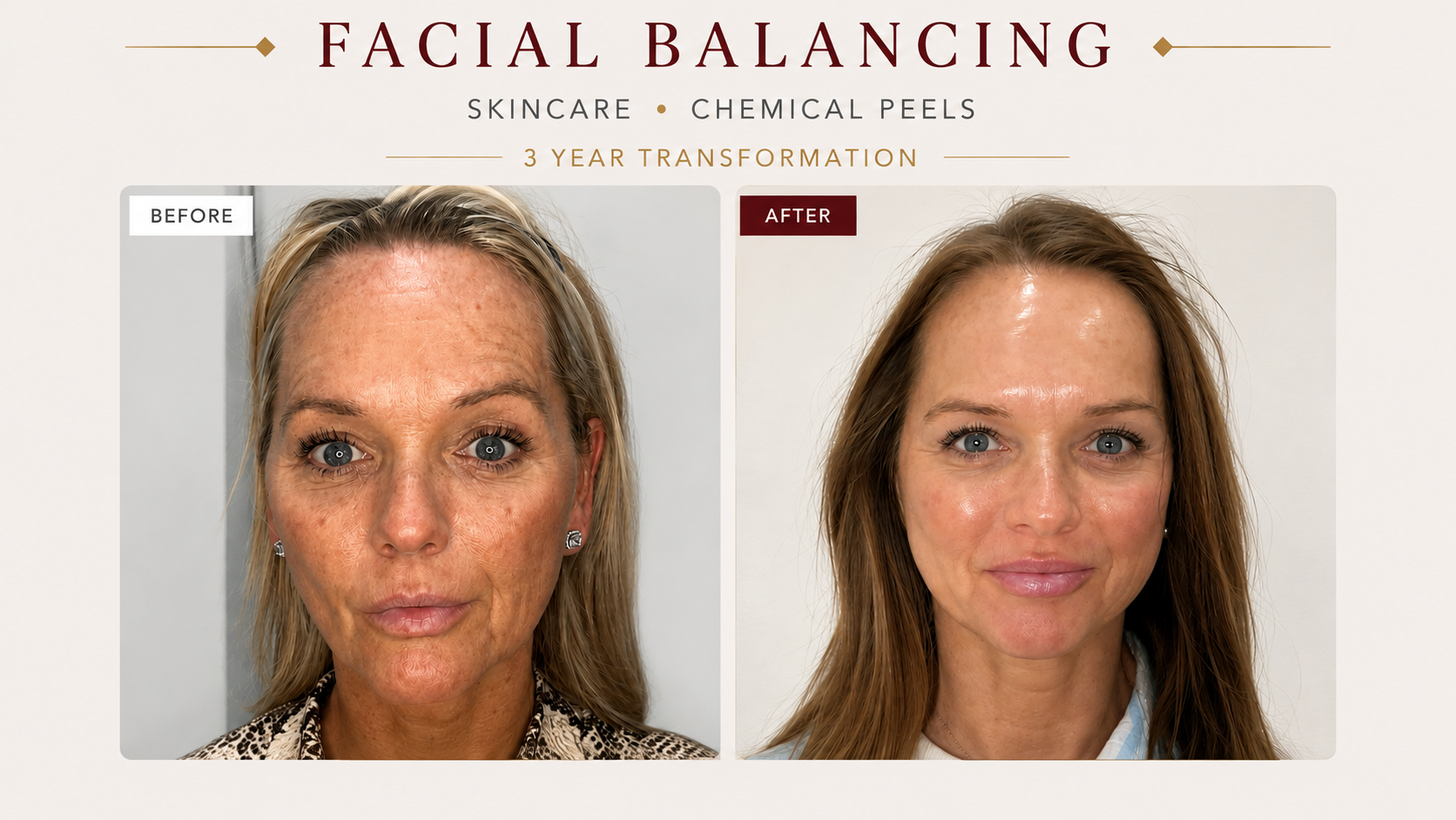 Three Year Facial Balancing Skincare and Chemical Peel Transformation at Taft Aesthetics in Wilson NC