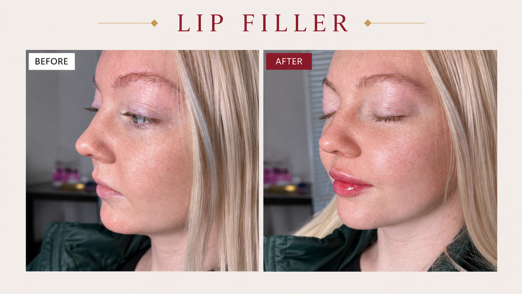 Before and After Lip Filler at Taft Aesthetics in Wilson NC