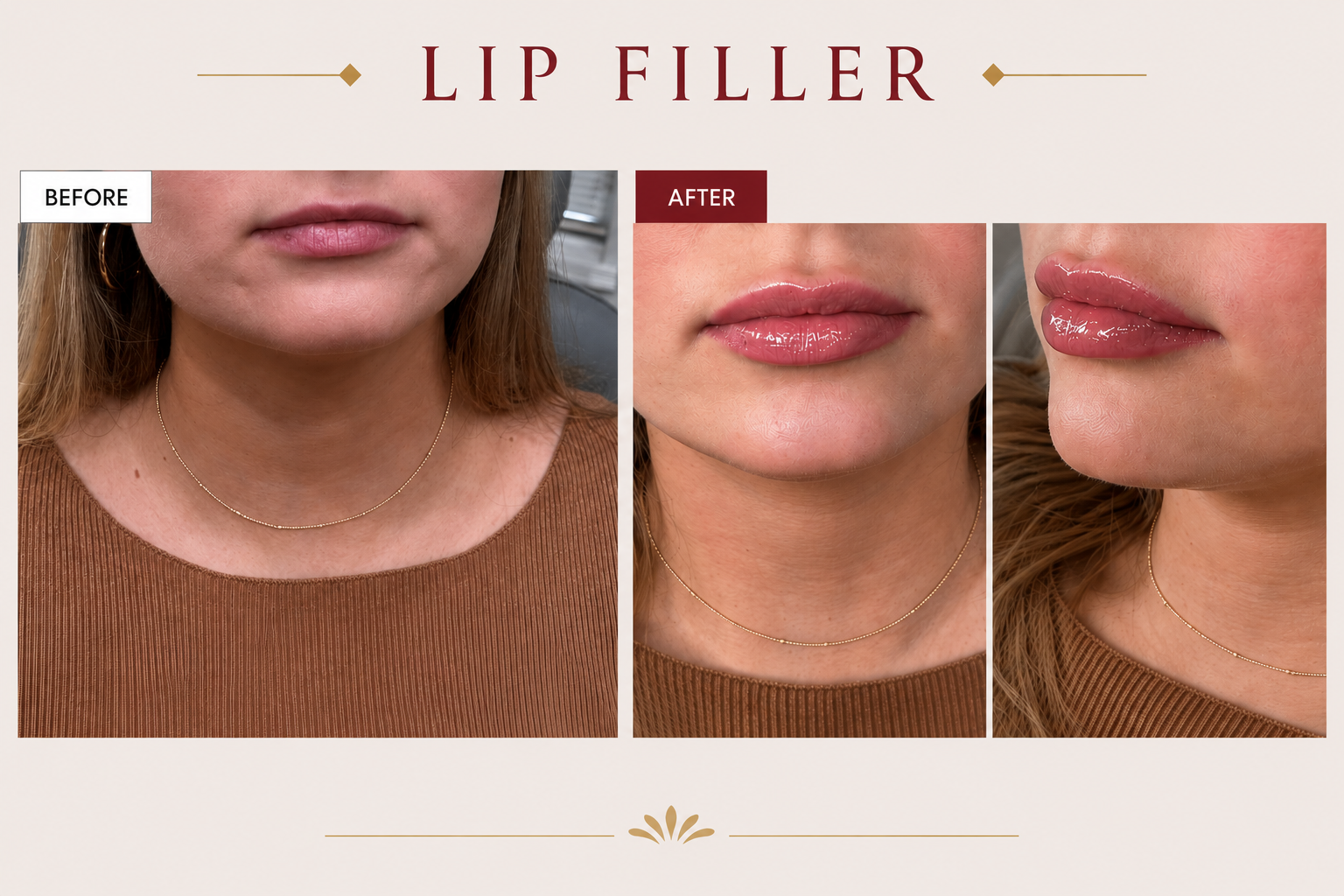 Before and After Lip Filler at Taft Aesthetics in Wilson NC
