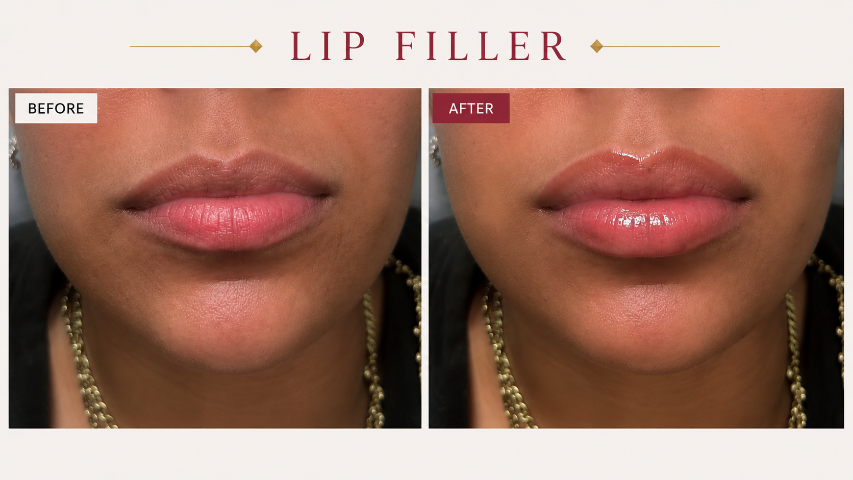 Before and After Lip Filler at Taft Aesthetics in Wilson NC