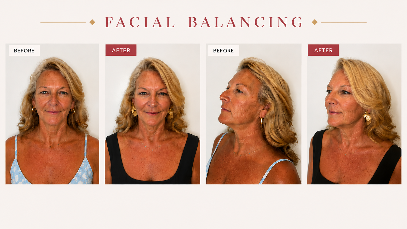 Before and After Facial Balancing at Taft Aesthetics in Wilson NC