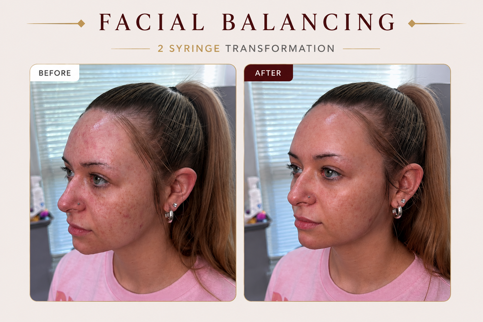 Before and After Facial Balancing at Taft Aesthetics in Wilson NC