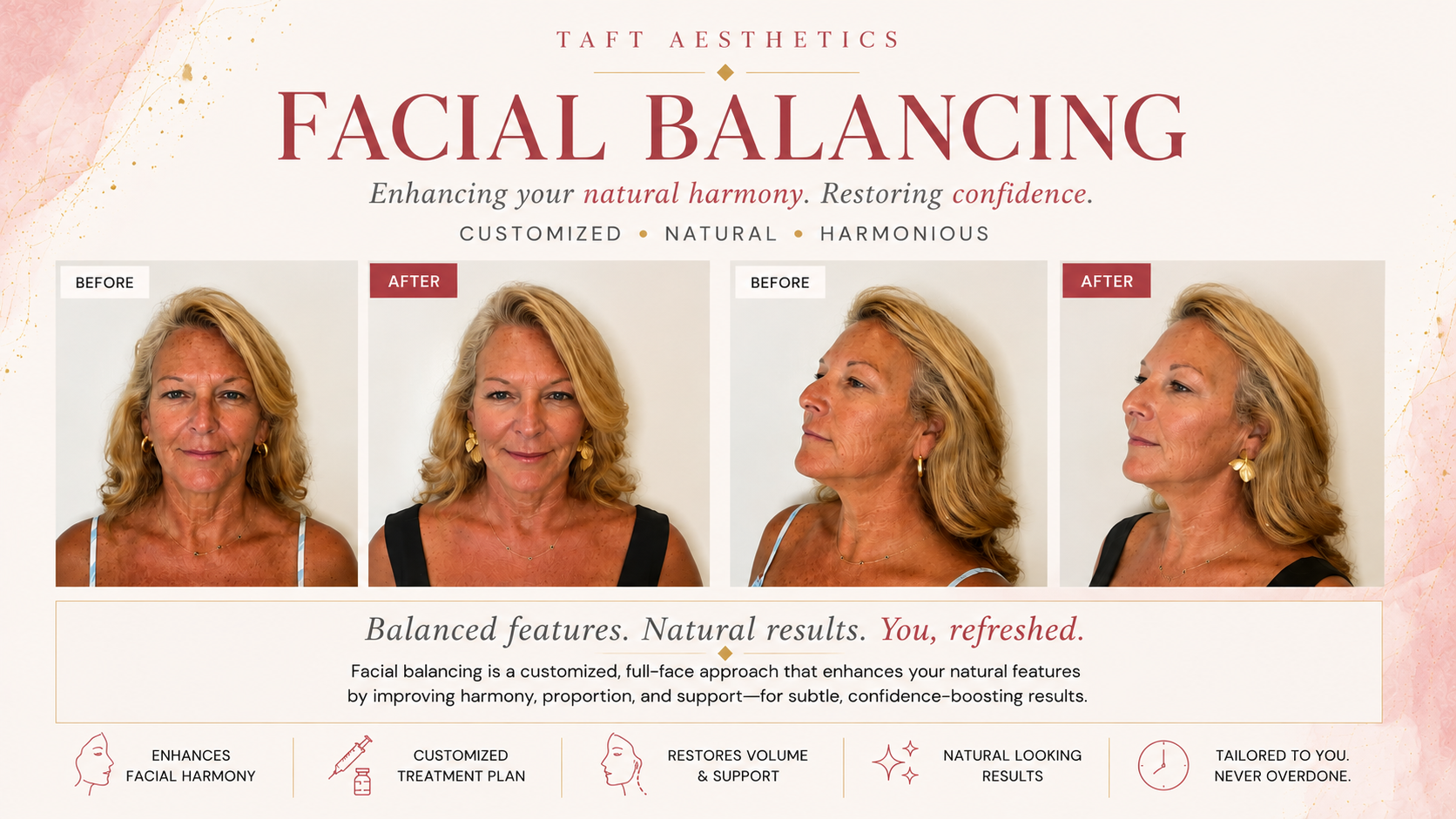 Before and After Facial Balancing at Taft Aesthetics LLC in Wilson NC